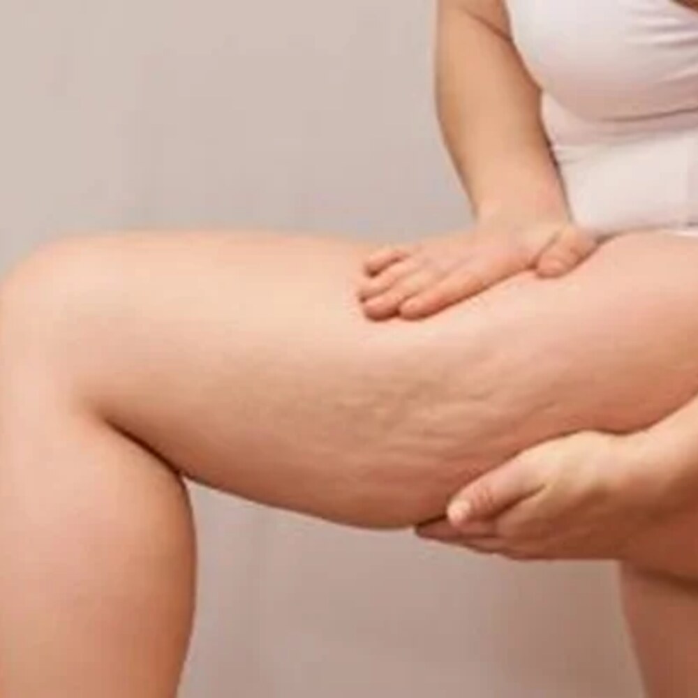 Tratamento de Lipedema
